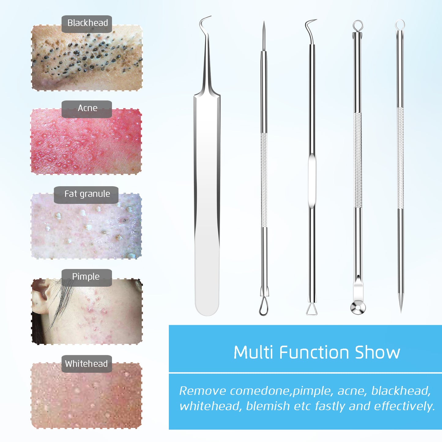 Premium Blackhead Remover, Comedone Blemish Acne Extractor,Popping Pimple Popper Whitehead Removal, Precision Tweezers, Zit Removing, Milia Remove